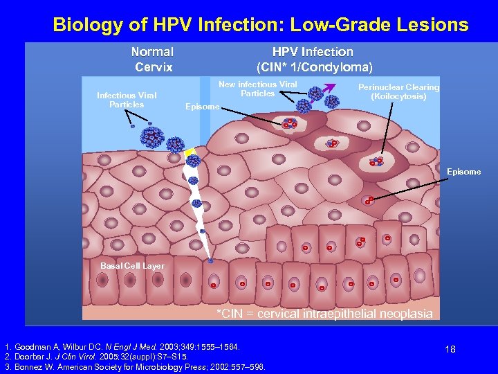 Biology of HPV Infection: Low-Grade Lesions Normal Cervix Infectious Viral Particles HPV Infection (CIN*