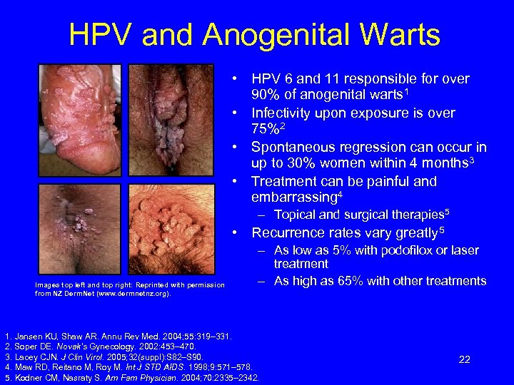 HPV and Anogenital Warts • HPV 6 and 11 responsible for over 90% of