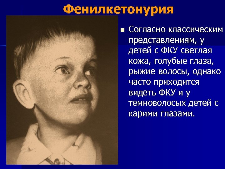 Фенилкетонурия n Согласно классическим представлениям, у детей с ФКУ светлая кожа, голубые глаза, рыжие