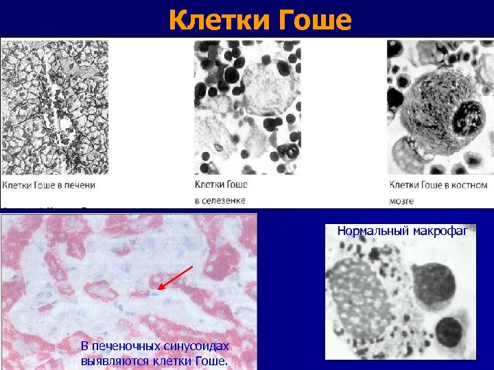 Клетки Гоше Нормальный макрофаг В печеночных синусоидах выявляются клетки Гоше. 