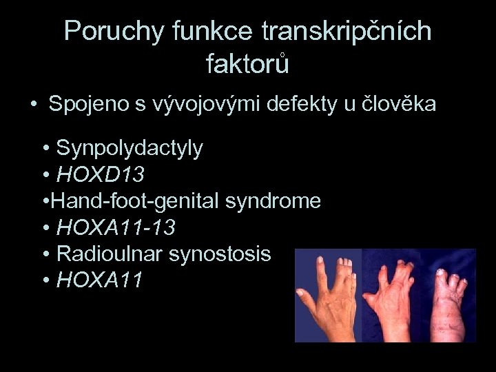 Poruchy funkce transkripčních faktorů • Spojeno s vývojovými defekty u člověka • Synpolydactyly •