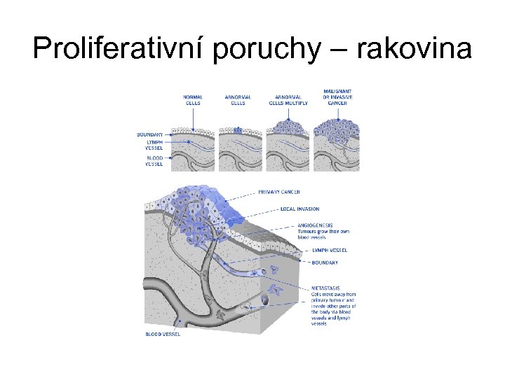 Proliferativní poruchy – rakovina 