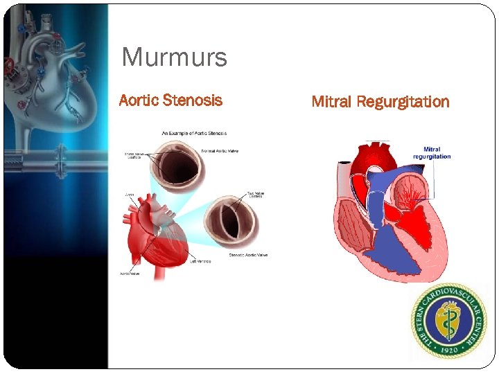 Murmurs Aortic Stenosis Mitral Regurgitation 