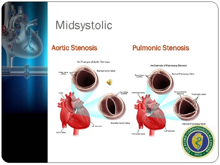 Midsystolic Aortic Stenosis Pulmonic Stenosis 