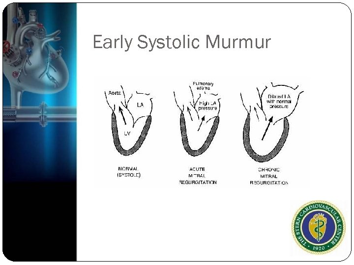 Early Systolic Murmur 