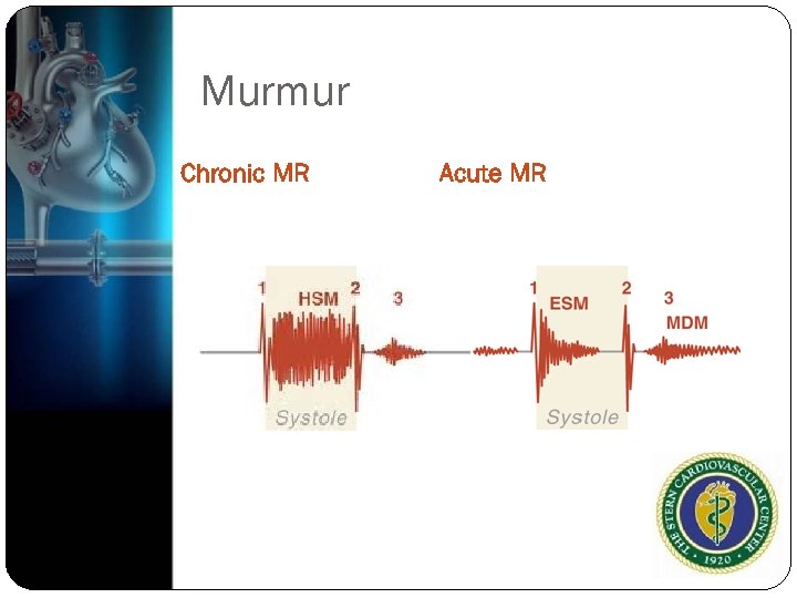 Murmur Chronic MR Acute MR 