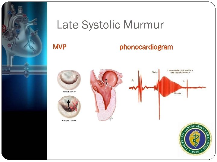 Late Systolic Murmur MVP phonocardiogram 