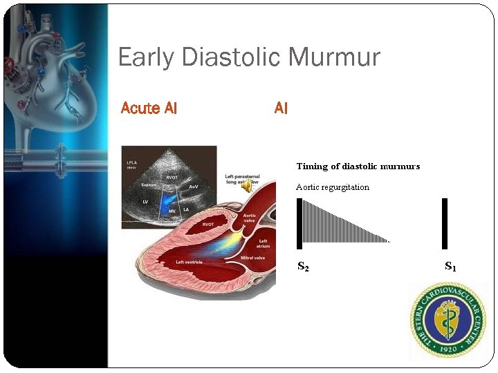 Early Diastolic Murmur Acute AI AI 
