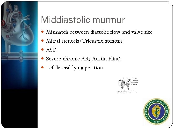 Middiastolic murmur Mismatch between diastolic flow and valve size Mitral stenosis/Tricuspid stenosis ASD Severe,