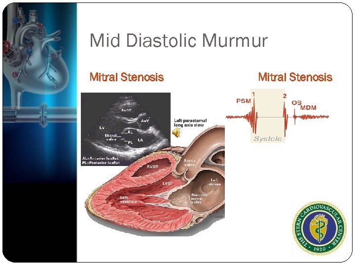 Mid Diastolic Murmur Mitral Stenosis 