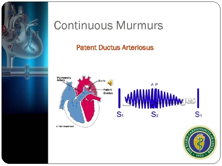Continuous Murmurs Patent Ductus Arteriosus 
