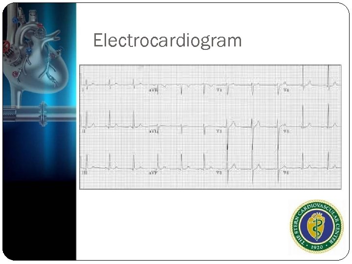 Electrocardiogram 