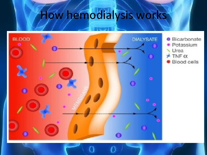 How hemodialysis works 