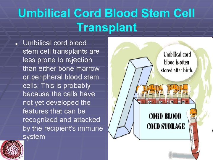 Umbilical Cord Blood Stem Cell Transplant Umbilical cord blood stem cell transplants are less
