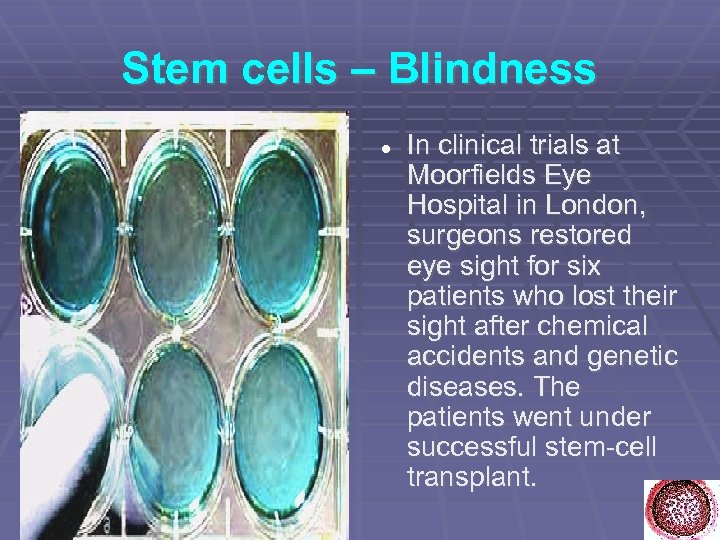 Stem cells – Blindness In clinical trials at Moorfields Eye Hospital in London, surgeons