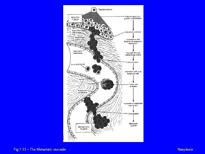 Fig 7. 33 – The Metastatic cascade Neoplasia 