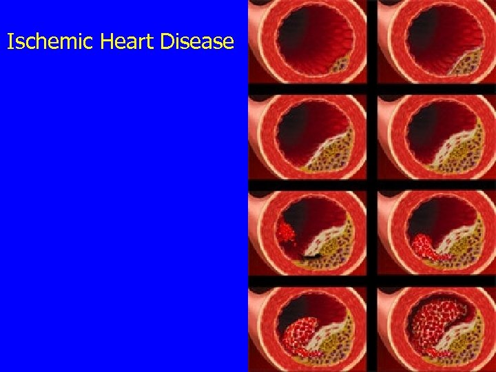 Ischemic Heart Disease 