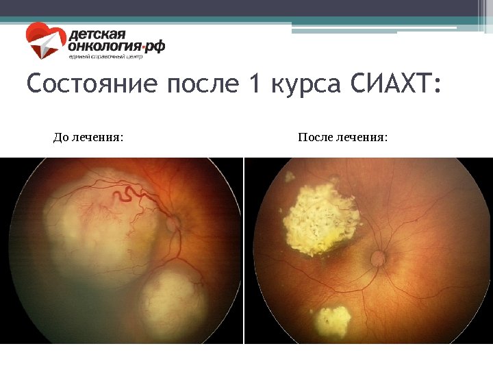 Состояние после 1 курса СИАХТ: До лечения: После лечения: 