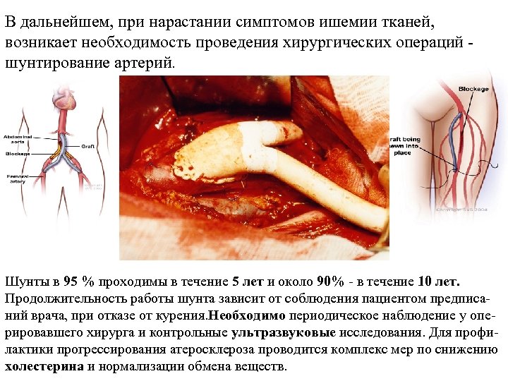 В дальнейшем, при нарастании симптомов ишемии тканей, возникает необходимость проведения хирургических операций - шунтирование