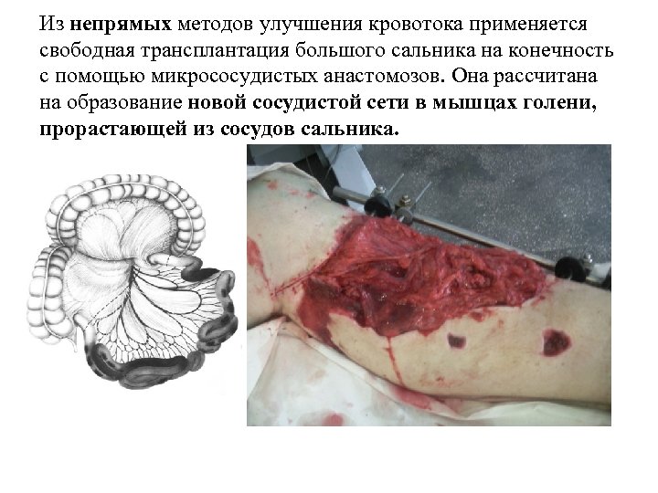 Из непрямых методов улучшения кровотока применяется свободная трансплантация большого сальника на конечность с помощью