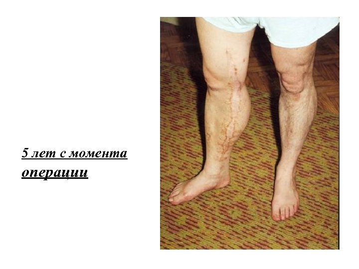 5 лет с момента операции 