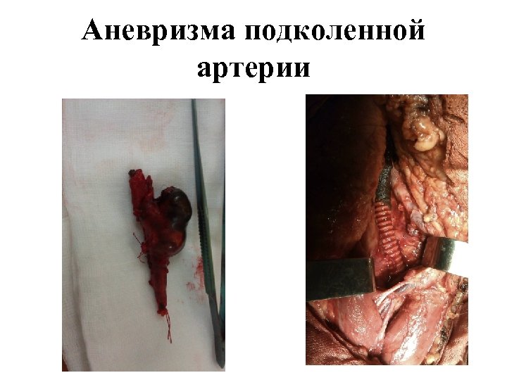 Аневризма подколенной артерии 