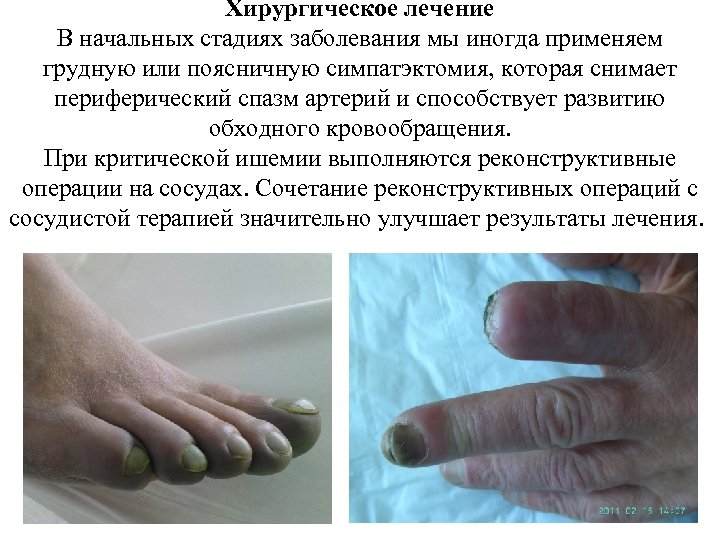 Хирургическое лечение В начальных стадиях заболевания мы иногда применяем грудную или поясничную симпатэктомия, которая