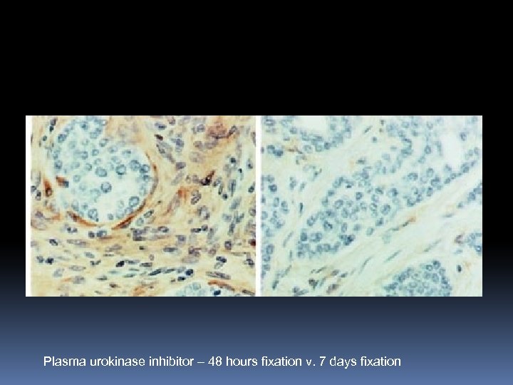 Plasma urokinase inhibitor – 48 hours fixation v. 7 days fixation 