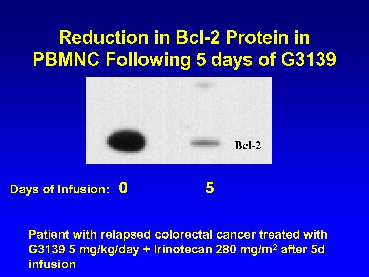 Reduction in Bcl-2 Protein in PBMNC Following 5 days of G 3139 Bcl-2 Days