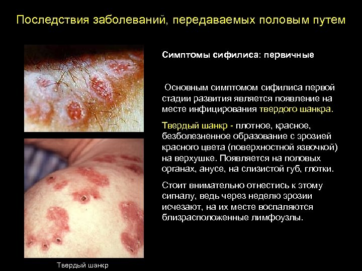 Последствия заболеваний, передаваемых половым путем Симптомы сифилиса: первичные Основным симптомом сифилиса первой стадии развития