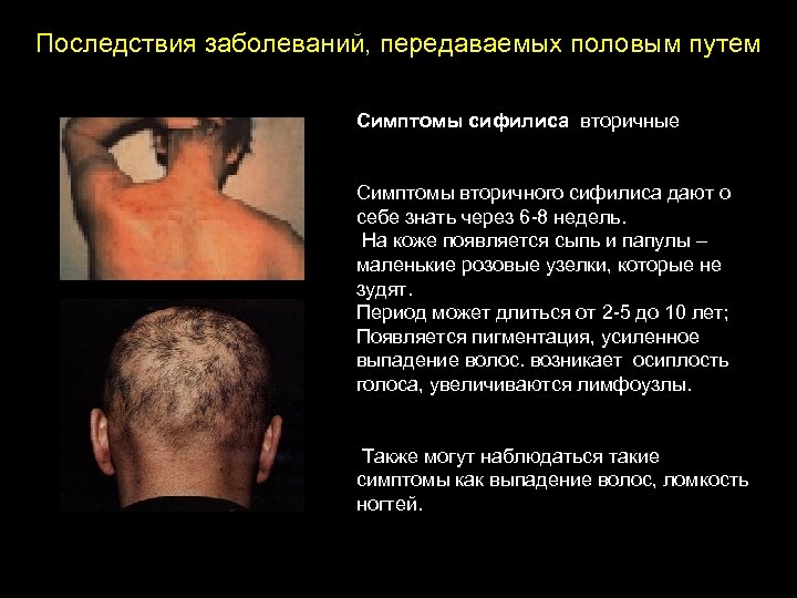 Последствия заболеваний, передаваемых половым путем Симптомы сифилиса вторичные Симптомы вторичного сифилиса дают о себе