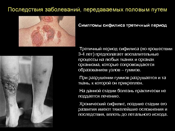 Последствия заболеваний, передаваемых половым путем Симптомы сифилиса третичный период Третичный период сифилиса (по прошествии
