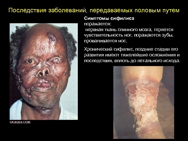 Последствия заболеваний, передаваемых половым путем Симптомы сифилиса поражается: нервная ткань спинного мозга, теряется чувствительность