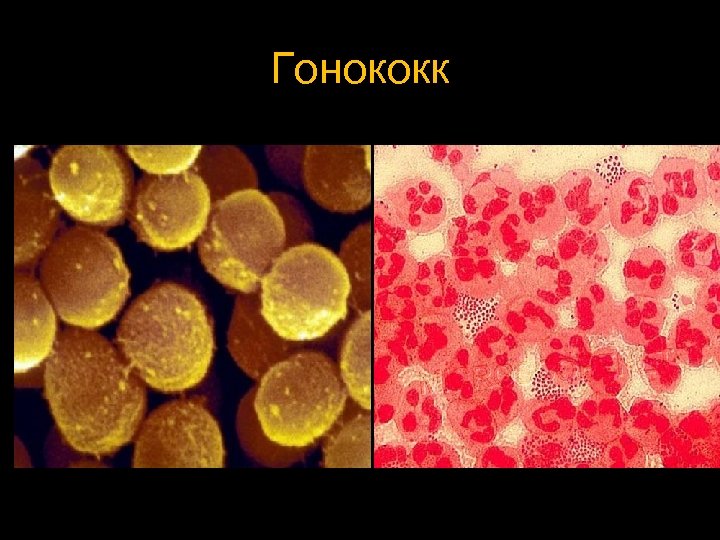 Гонококк 