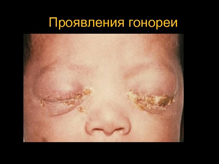 Проявления гонореи 
