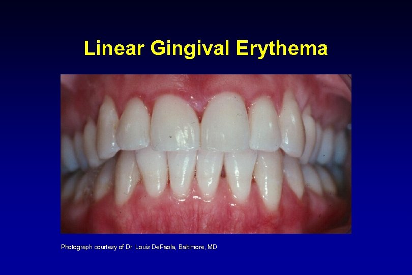 Linear Gingival Erythema Photograph courtesy of Dr. Louis De. Paola, Baltimore, MD 