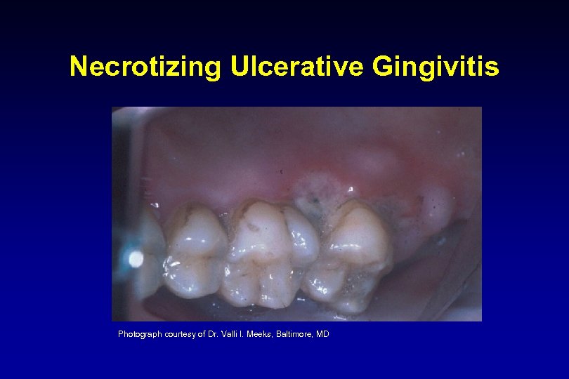 Necrotizing Ulcerative Gingivitis Photograph courtesy of Dr. Valli I. Meeks, Baltimore, MD 