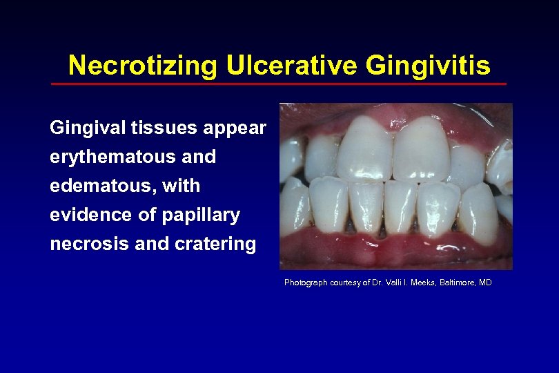 Necrotizing Ulcerative Gingivitis Gingival tissues appear erythematous and edematous, with evidence of papillary necrosis