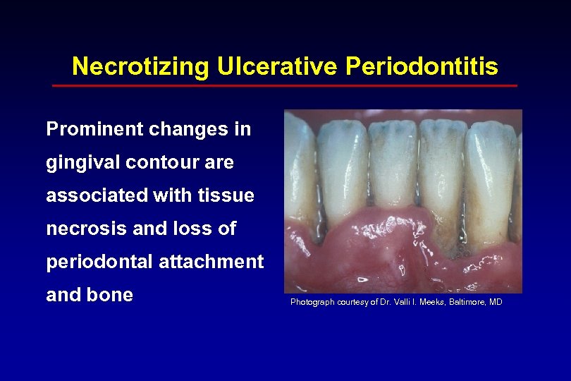 Necrotizing Ulcerative Periodontitis Prominent changes in gingival contour are associated with tissue necrosis and