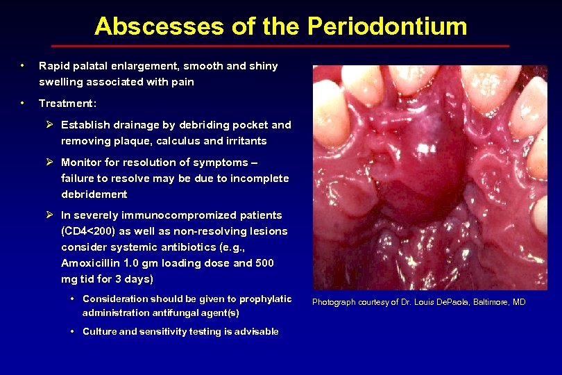 Abscesses of the Periodontium • Rapid palatal enlargement, smooth and shiny swelling associated with