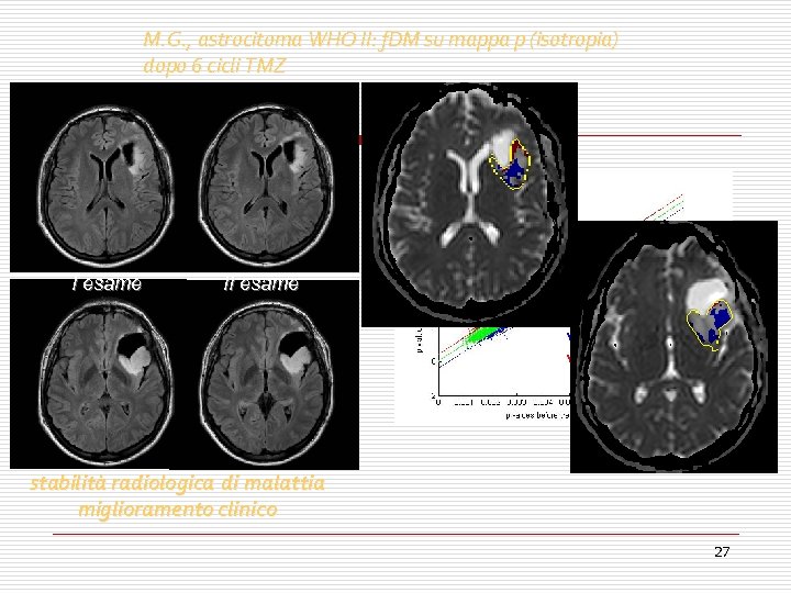 M. G. , astrocitoma WHO II: f. DM su mappa p (isotropia) dopo 6