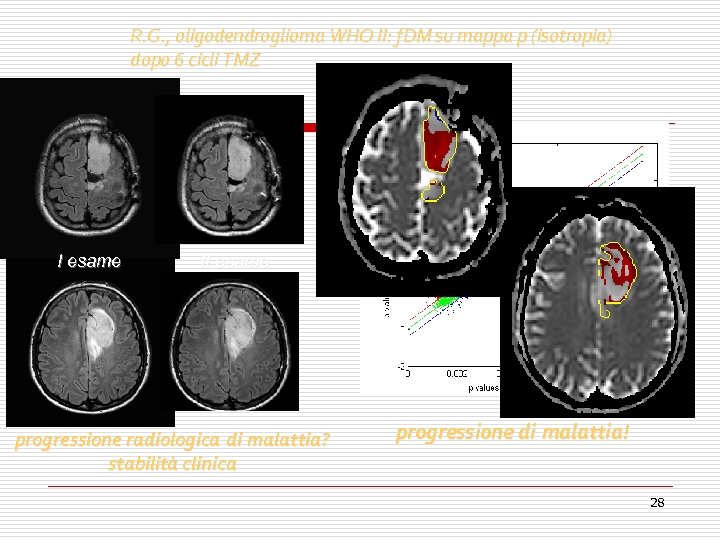 R. G. , oligodendroglioma WHO II: f. DM su mappa p (isotropia) dopo 6