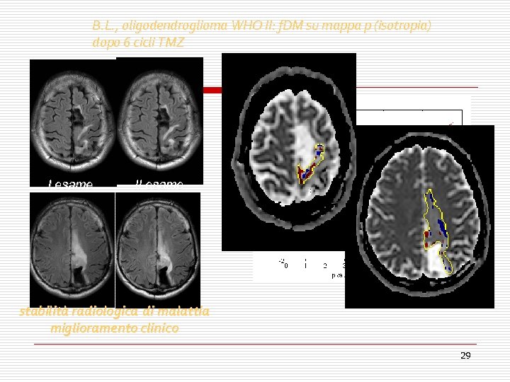 B. L. , oligodendroglioma WHO II: f. DM su mappa p (isotropia) dopo 6