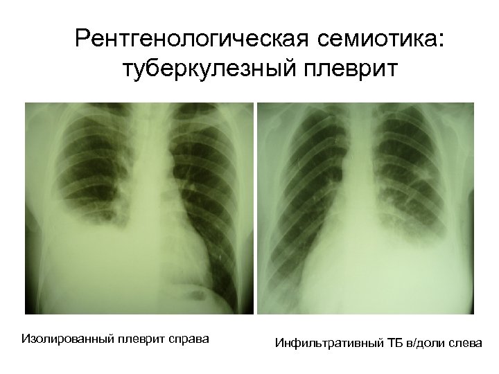 Рентгенологическая семиотика: туберкулезный плеврит Изолированный плеврит справа Инфильтративный ТБ в/доли слева 