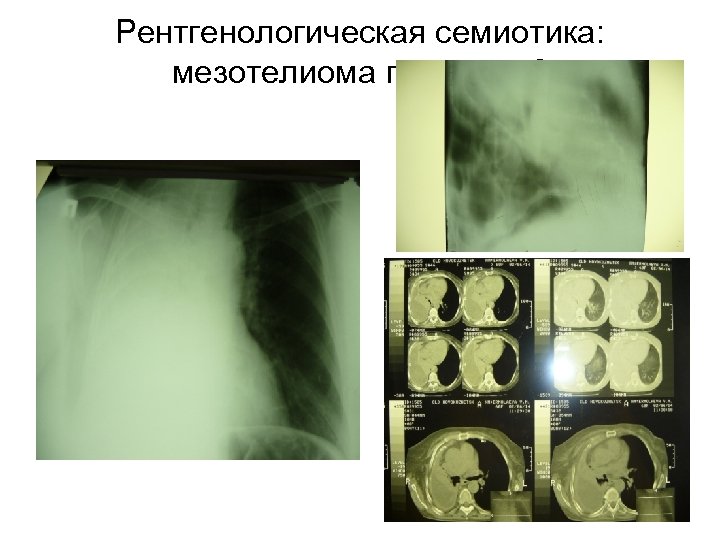 Рентгенологическая семиотика: мезотелиома плевры - 6 