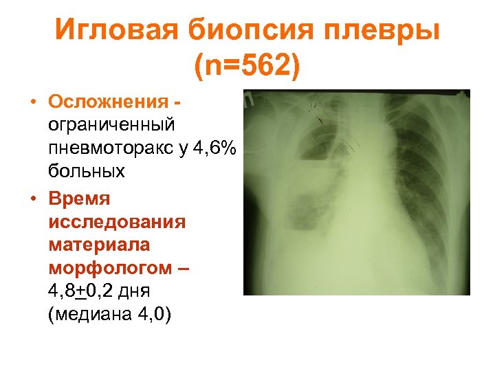 Игловая биопсия плевры (n=562) • Осложнения - ограниченный пневмоторакс у 4, 6% больных •