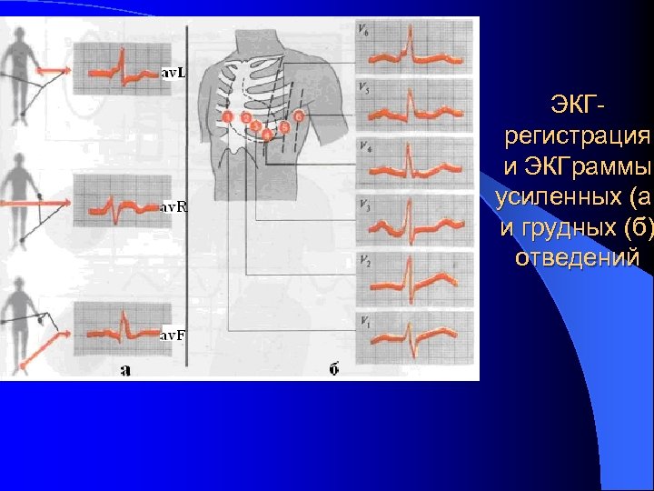 ЭКГрегистрация и ЭКГраммы усиленных (а) и грудных (б) отведений 