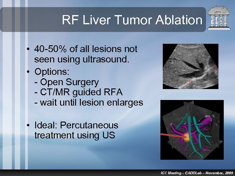RF Liver Tumor Ablation • 40 -50% of all lesions not seen using ultrasound.