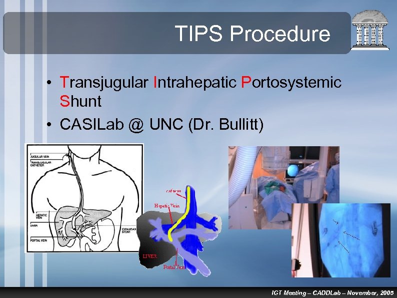TIPS Procedure • Transjugular Intrahepatic Portosystemic Shunt • CASILab @ UNC (Dr. Bullitt) IGT