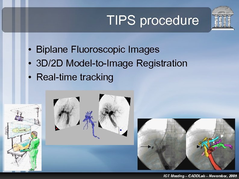TIPS procedure • Biplane Fluoroscopic Images • 3 D/2 D Model-to-Image Registration • Real-time